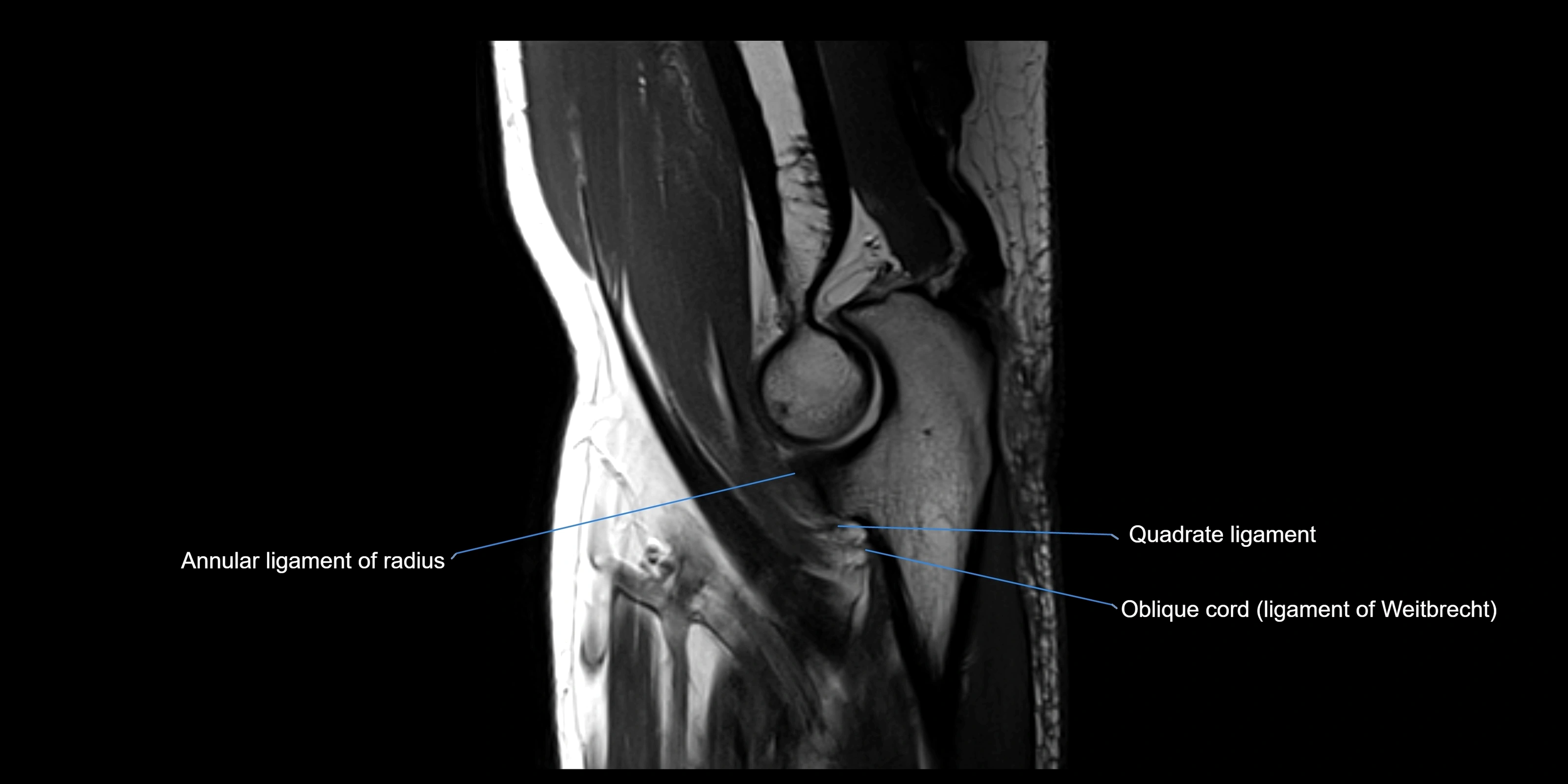MRI elbow sagittal cross sectional anatomy 3T radiology  image-img-00001-00014.webp